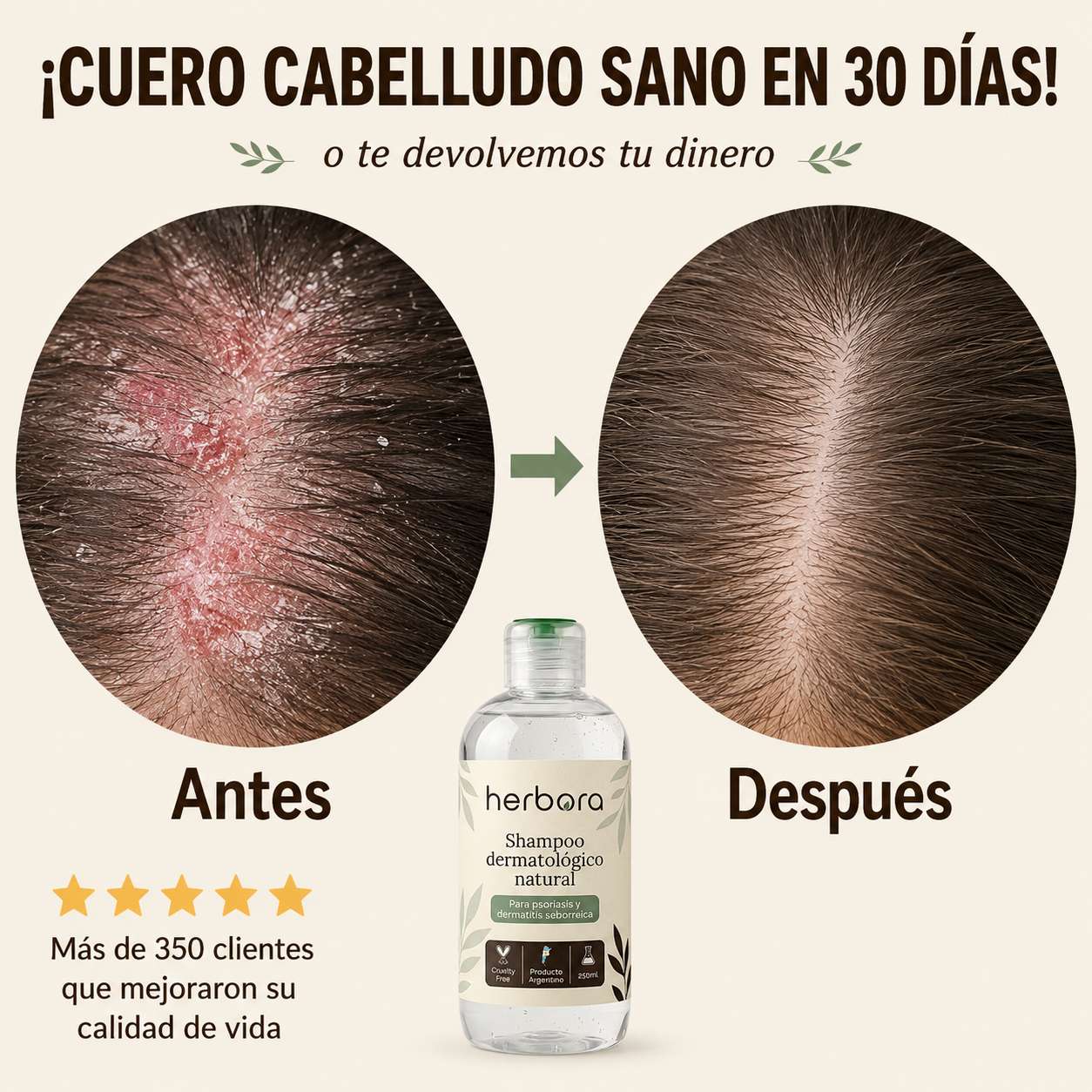 Herbora | Shampoo para la caspa, psoriasis capilar y dermatitis seborreica