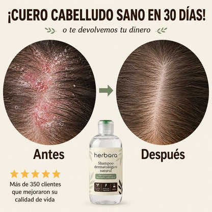 Herbora | Shampoo para la caspa, psoriasis capilar y dermatitis seborreica
