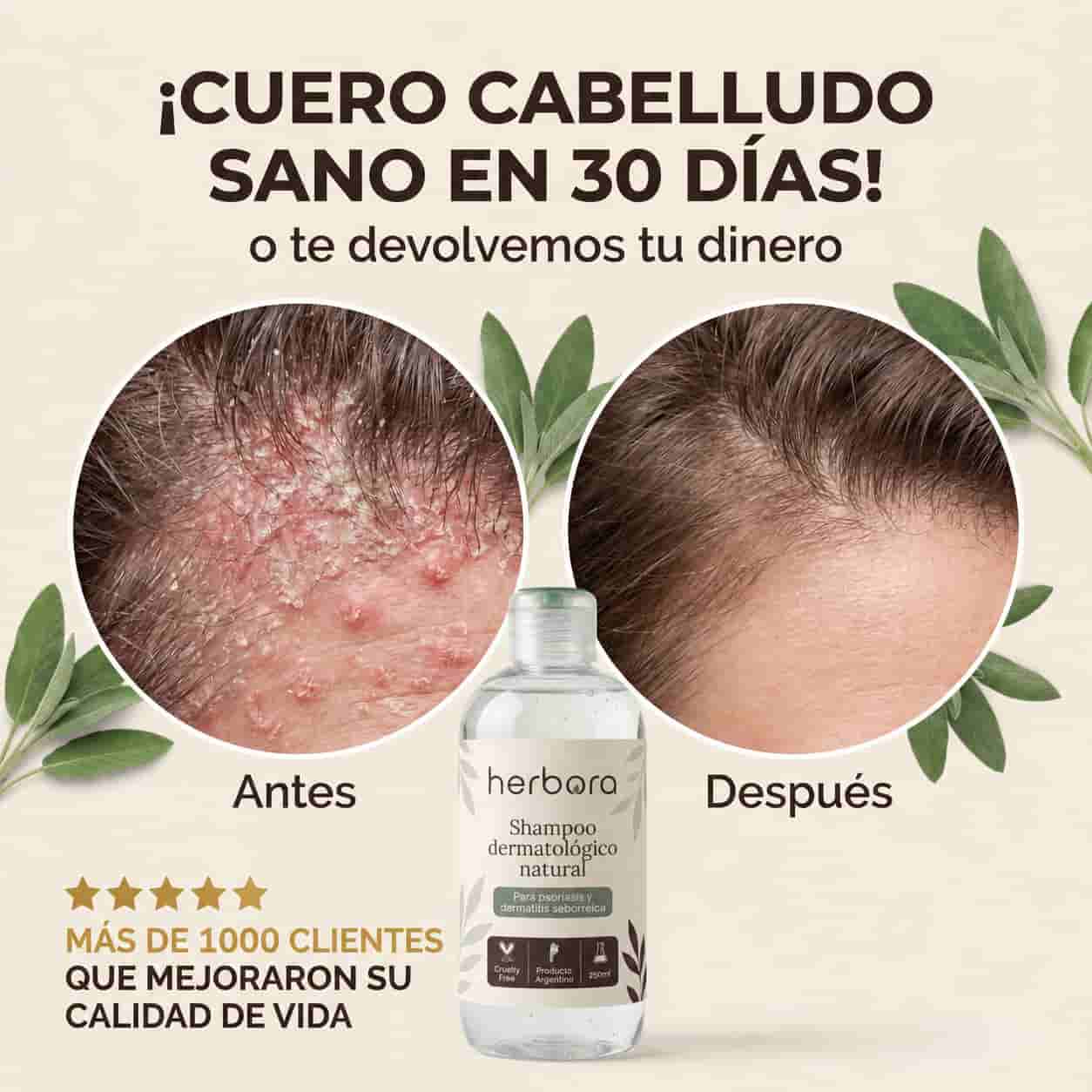 Herbora | Shampoo para la caspa, psoriasis capilar y dermatitis seborreica
