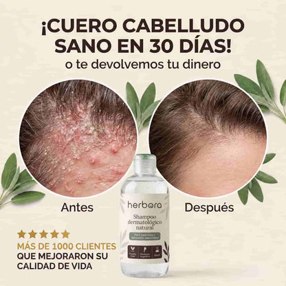 Herbora | Shampoo para la caspa, psoriasis capilar y dermatitis seborreica